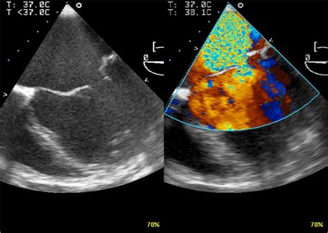 2d echo with cfd|2D Doppler Echocardiogram with Color Flow .
